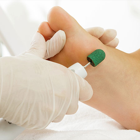 Remo&ccedil;&atilde;o de Calosidades